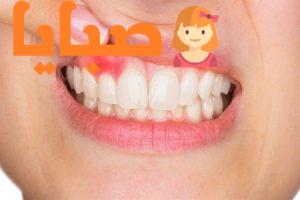 التهاب اللثة :أسباب وأعراض وطرق العلاج والوقاية (Gingivitis) 1