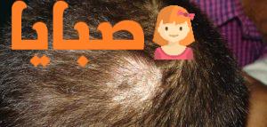 ما هو مرض الثعلبة ؟ 1