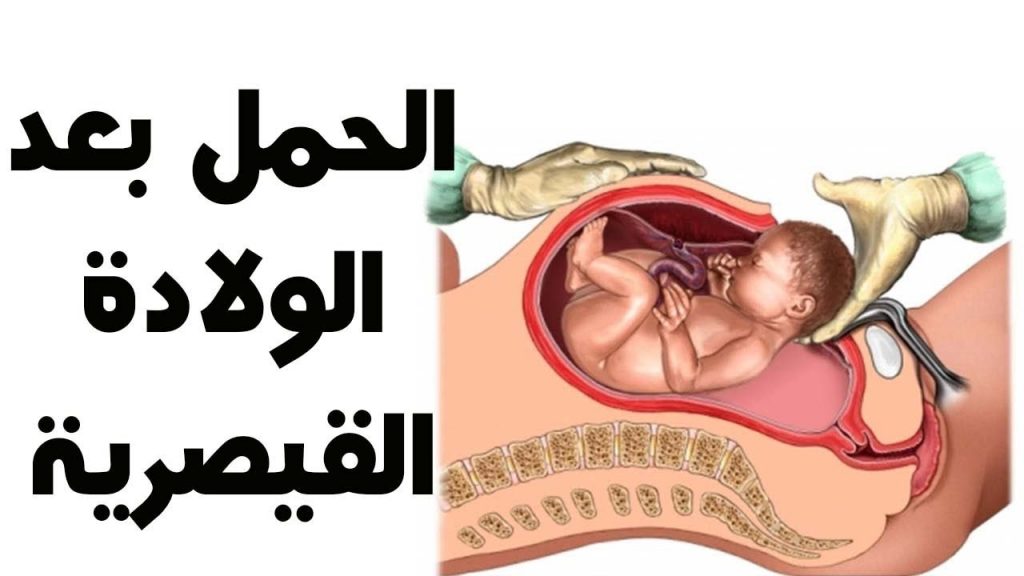 الحمل بعد الولادة القيصرية