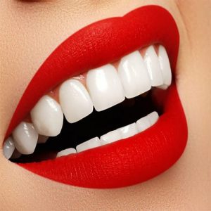 ابتسامة هوليوود HOLLYWOOD SMILE حلم أصبح واقعياً 1