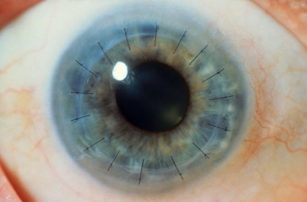 عملية تثبيت القرنية