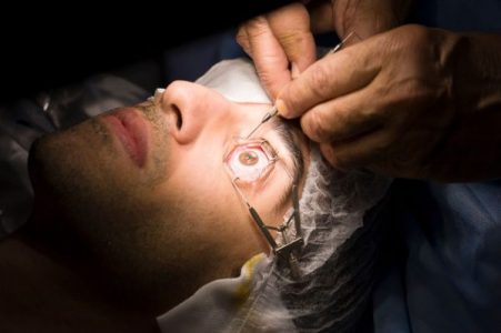 عمليات الليزك للعيون - علاج ضعف الإبصار 2